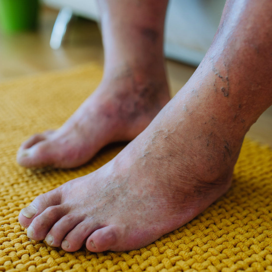 Diabetic Foot Care