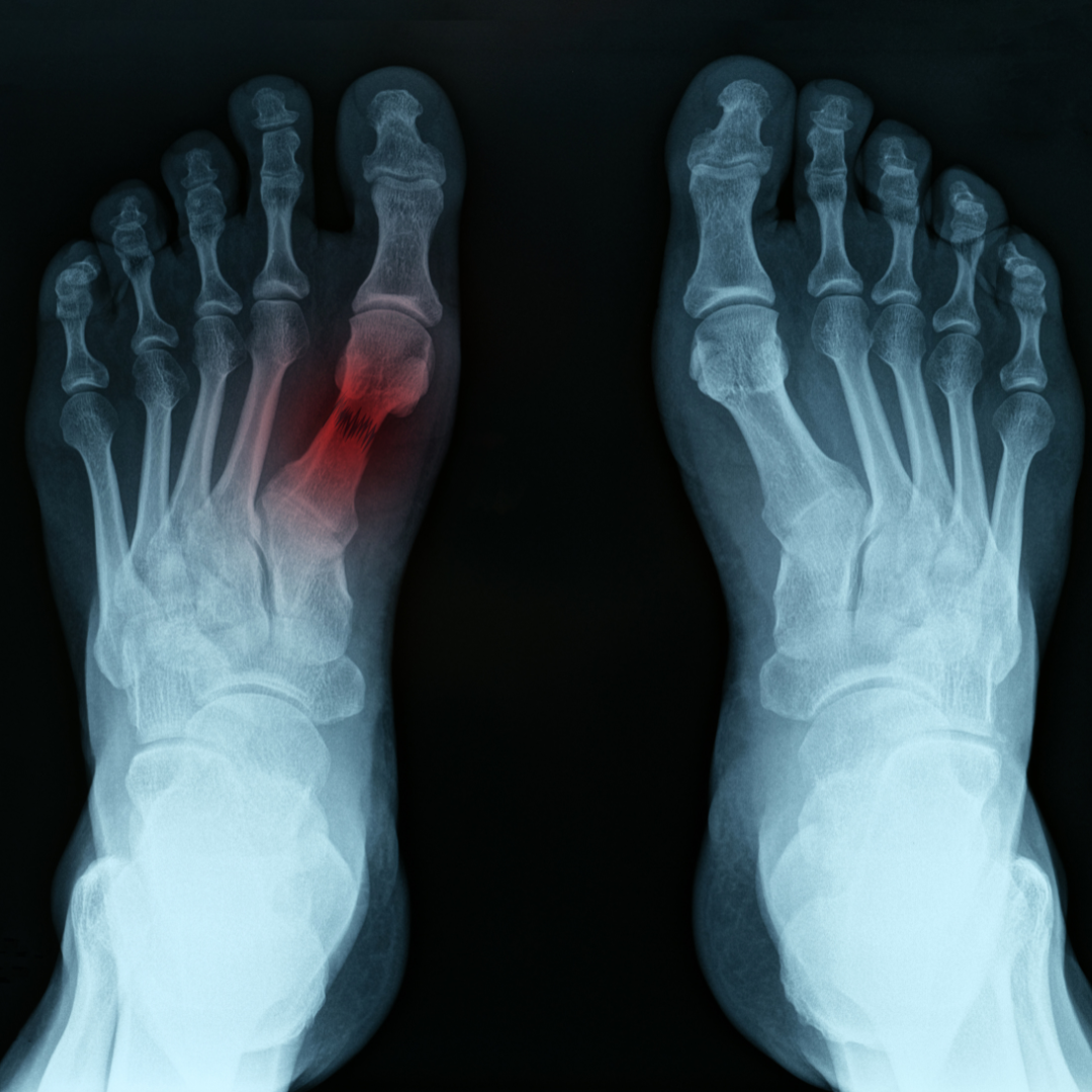 Foot Fractures