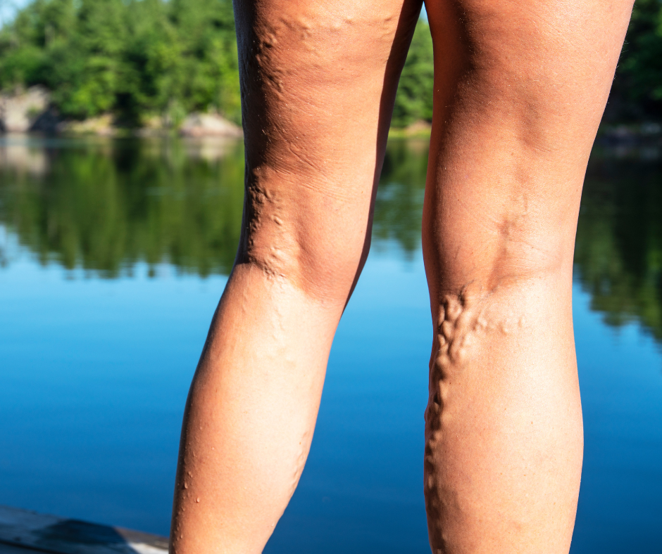 What Causes Varicose Veins in Legs? - Vein Center of Brinton Lake