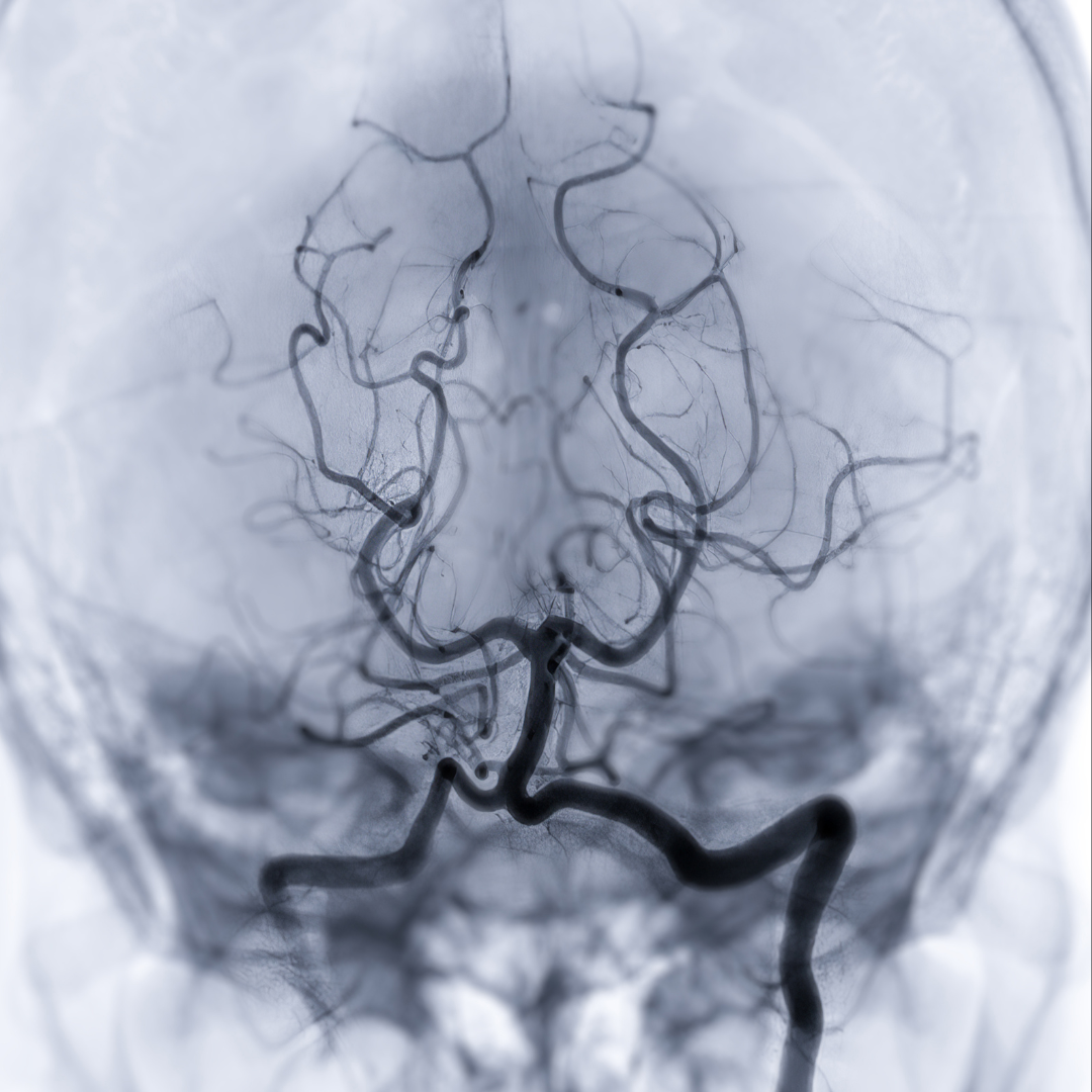 fluoroscopy