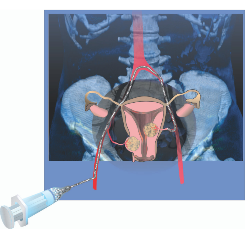 Uterine Fibroid Embolization Blue Rock Medical 