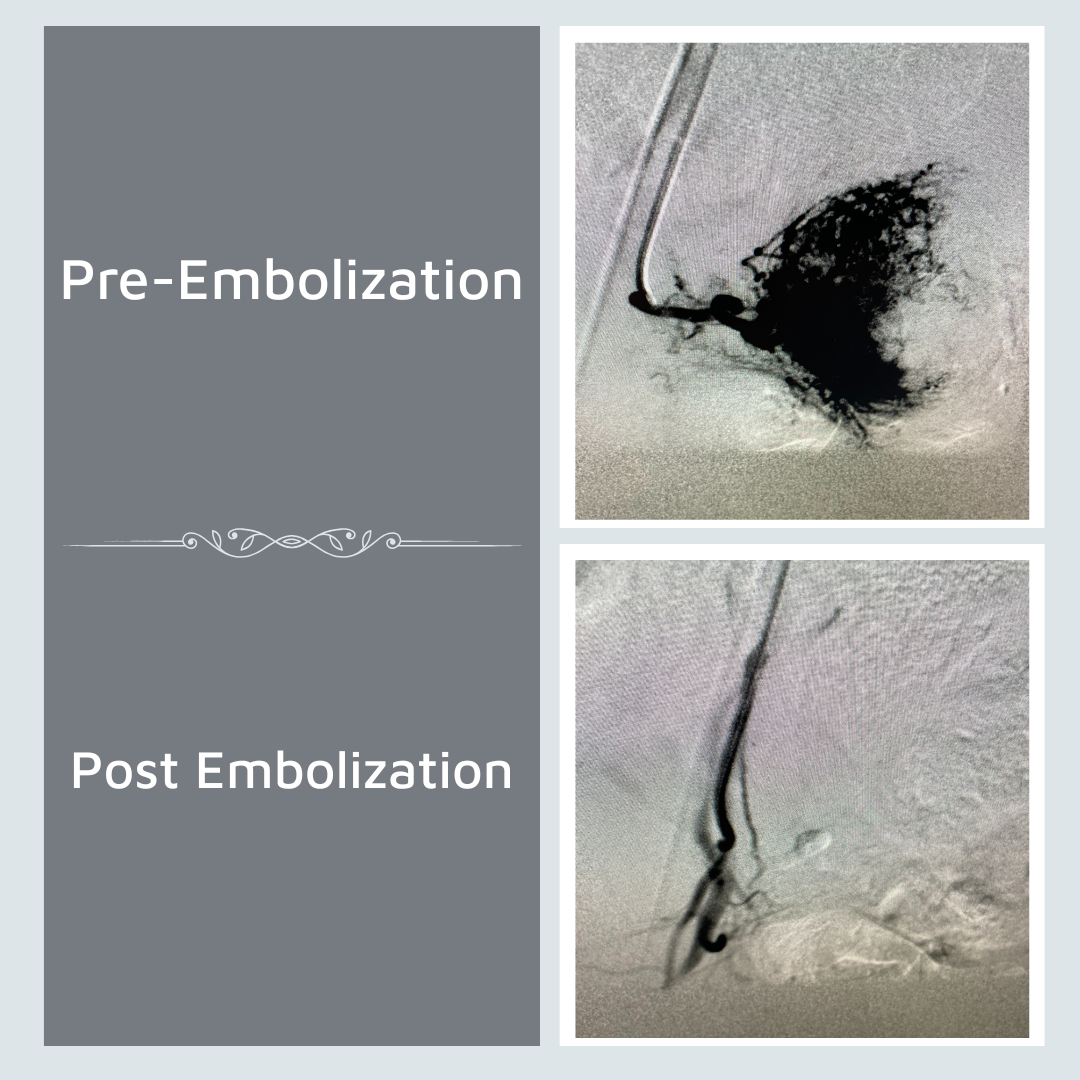 Embolization Before and After