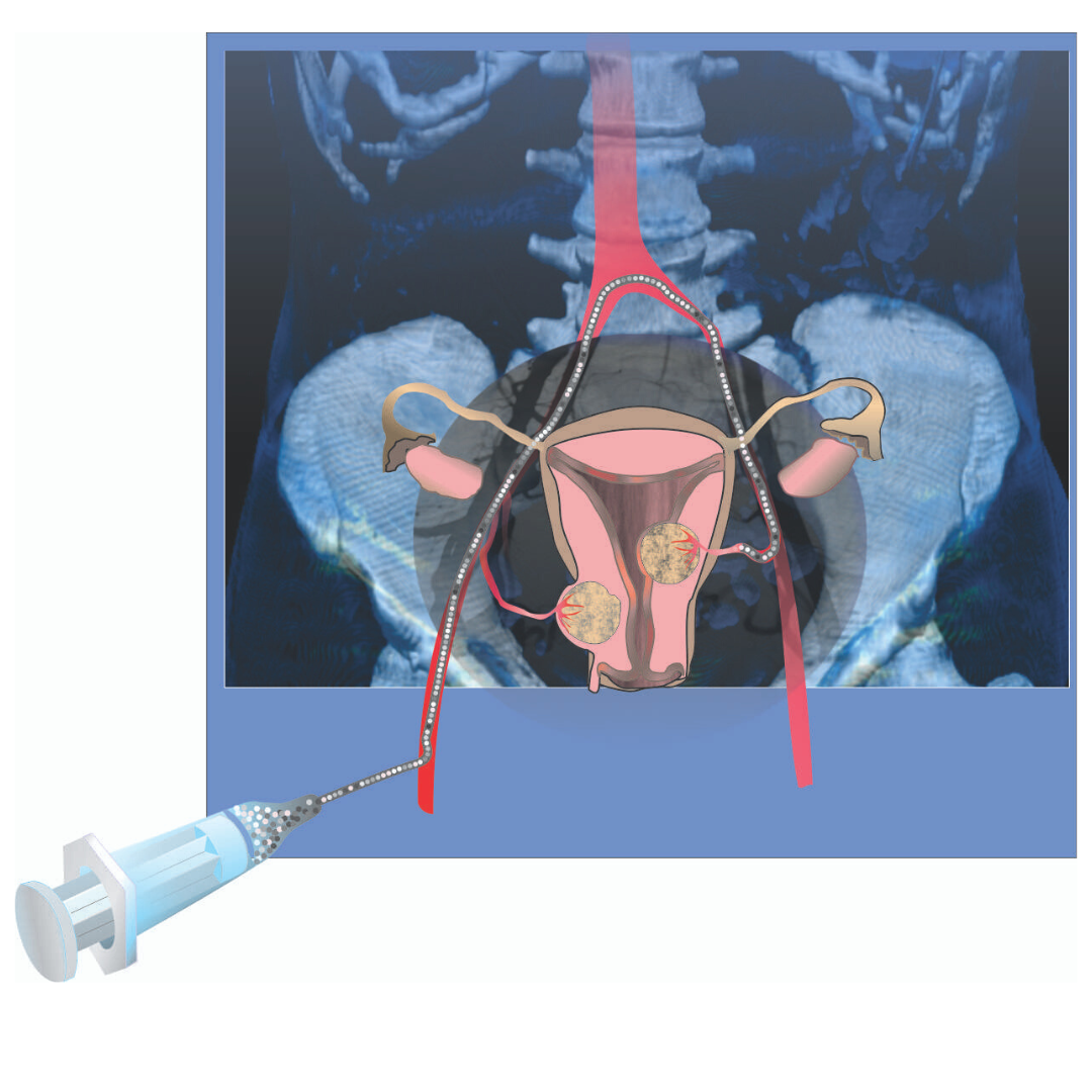 Uterine Fibroid Embolization Blog