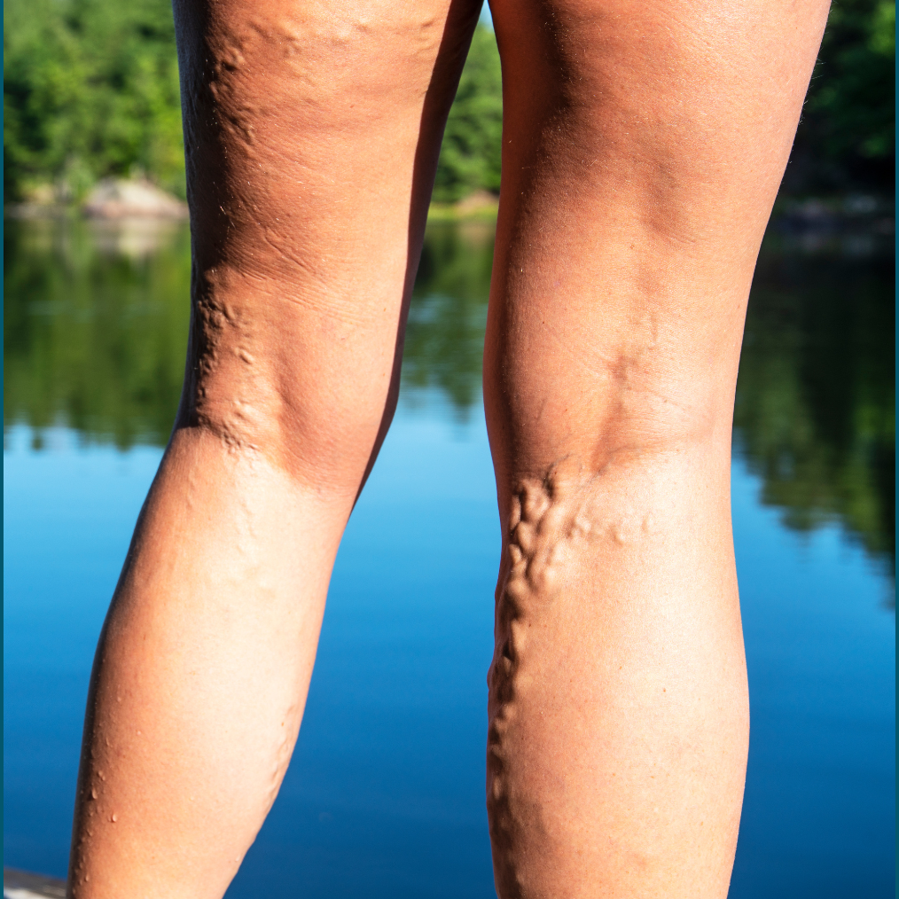Varicose Vein Blog